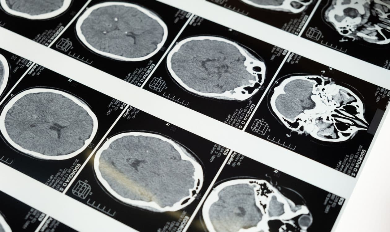 Pituitary Tumor Treatment