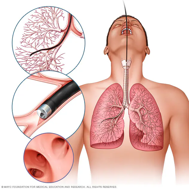 Interventional Bronchoscopy