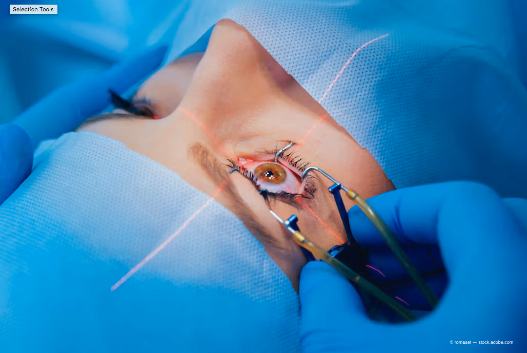 Cataract Surgery