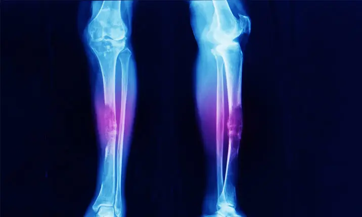 Sarcoma — Bone & Soft Tissue Cancer Treatment