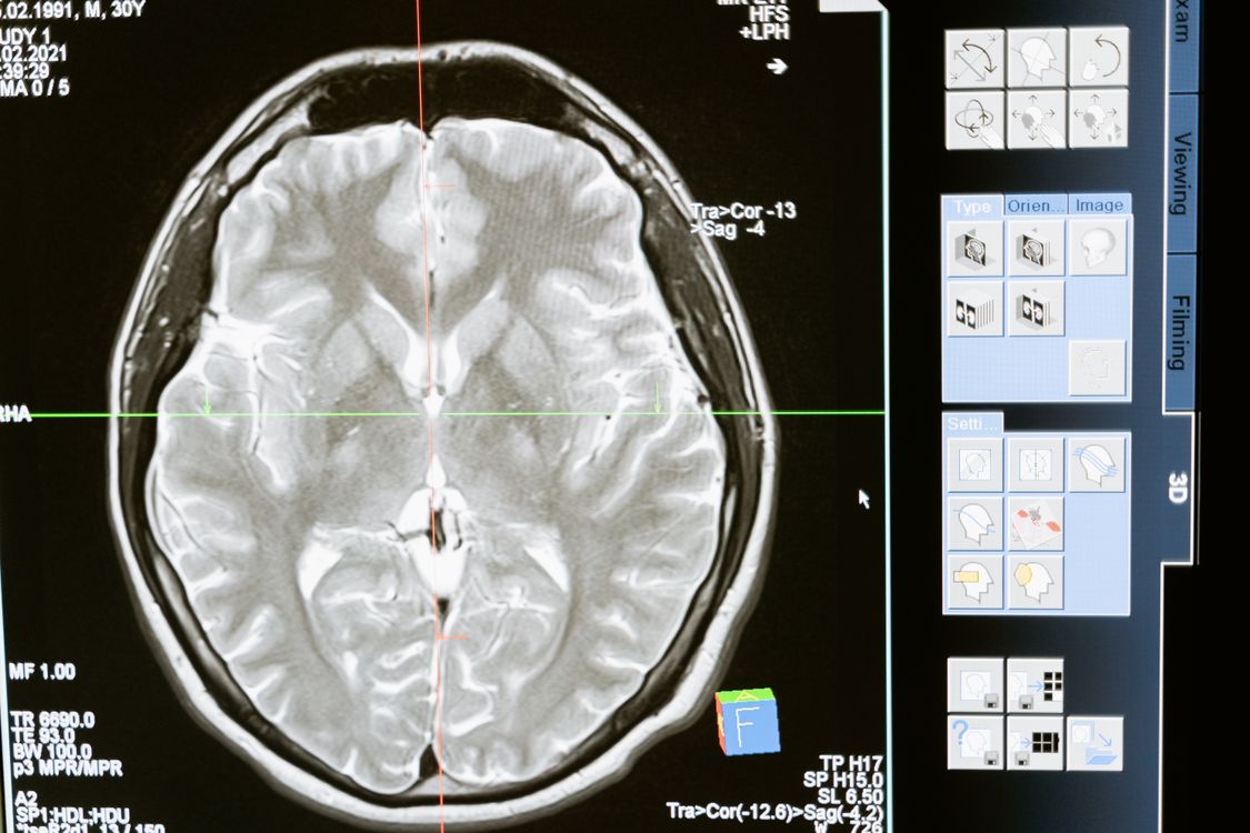 Deep Brain Stimulation