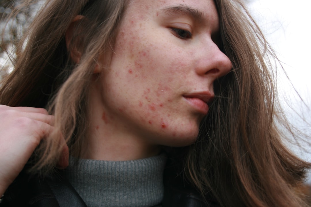 Autoimmune Skin Disorder Treatment