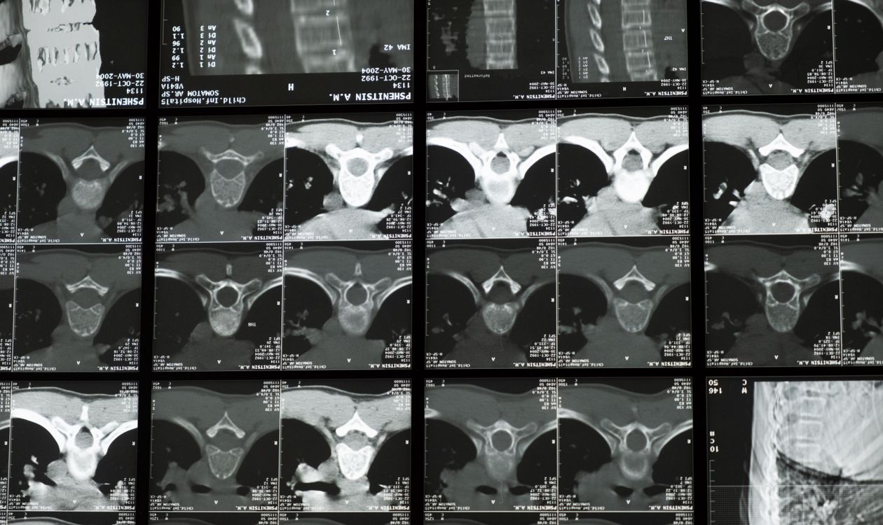 Parathyroid Disorder Treatment