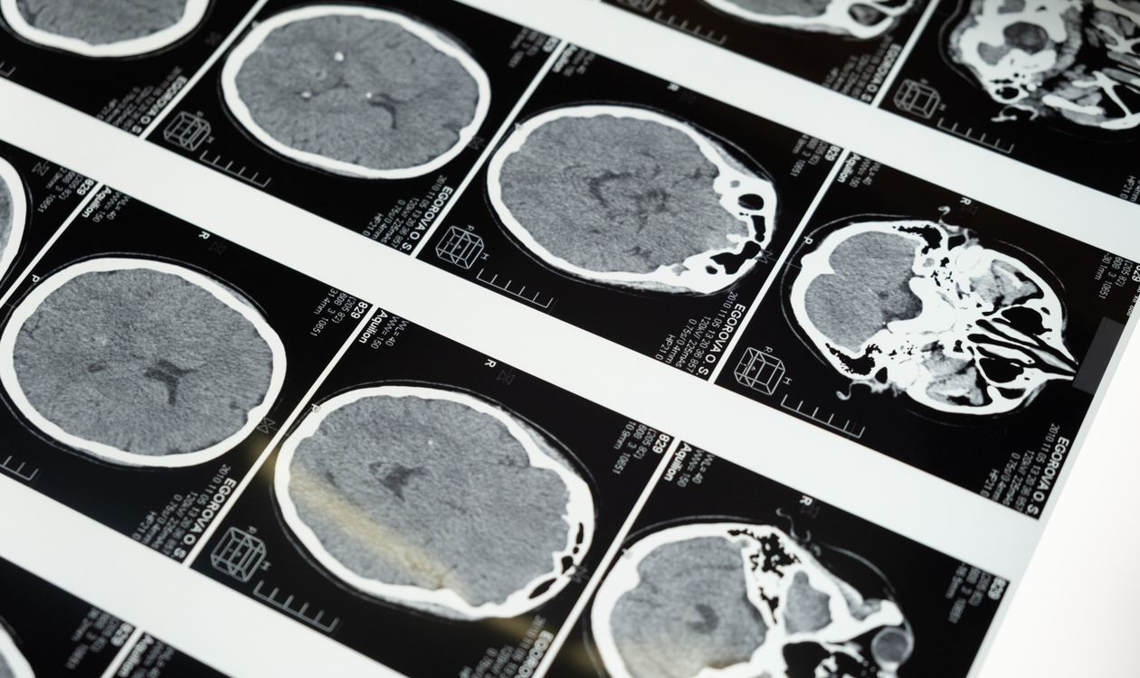 Pituitary Tumor Treatment