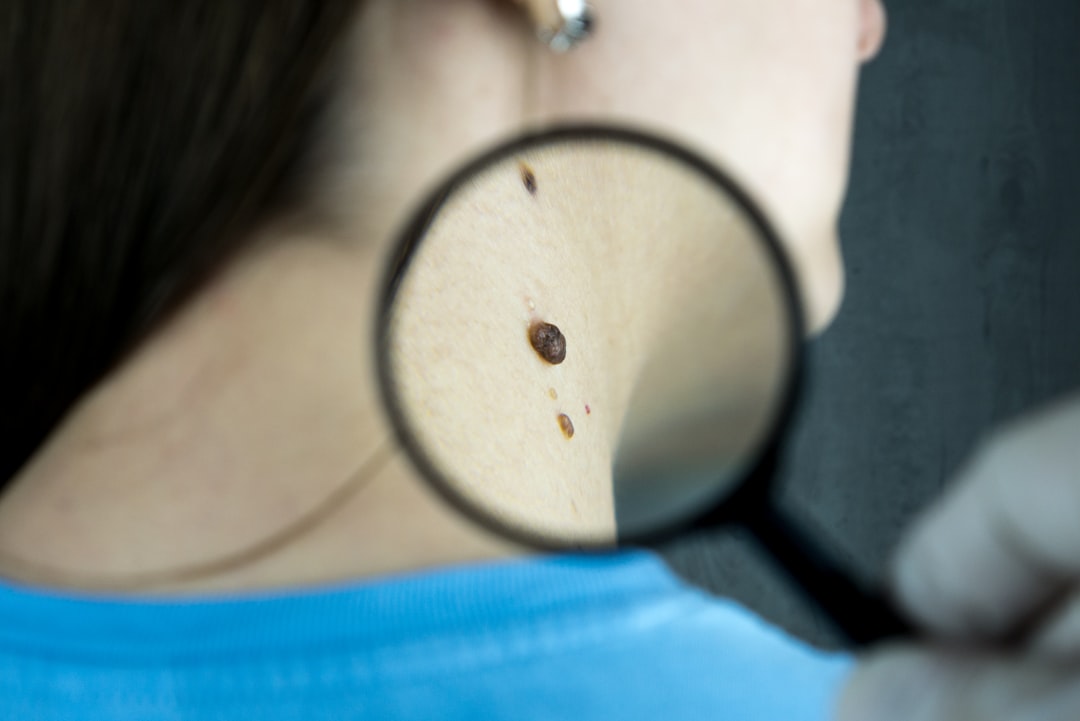 Skin Cancer Diagnosis & Surgical Removal